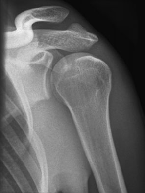 Radiografie anteroposterioară (AP) oblică a capului humerusului evidențiind