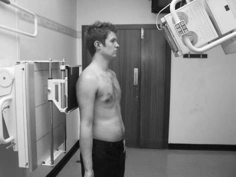 ența osteofitelor sau a unui acromion anormal de lung.