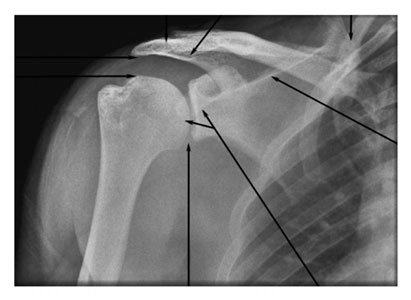 • Spațiul articular subacromial trebuie vizualizat deasupra [fragment deteriorat în sursă]