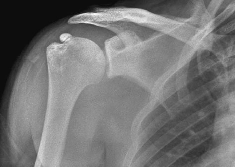 Radiografie anteroposterioară (AP) de umăr, incidență outlet, evidențiind suprafața inferioară normală