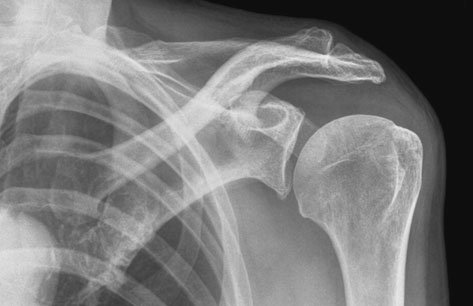 a acromionului (calcificări patologice incidentale ale tendonului supraspinos)