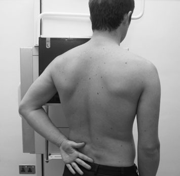 Radiografie normală de umăr, incidență outlet de profil (lateral)