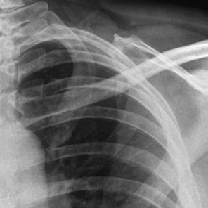 Radiografie anteroposterioară (AP) colimată a primei și celei de-a doua coaste stângi (grilaj costal)