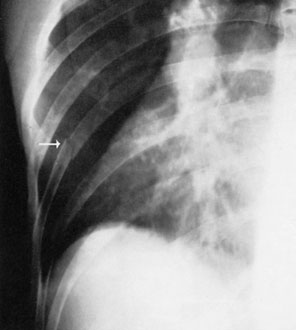Contrast radiografic care să permită vizualizarea adecvată a coastelor (grilajului costal)