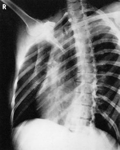 Radiografie a coastelor inferioare drepte (grilaj costal), evidențiind suspiciunea unei fracturi acute