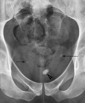 Imagine antero-posterioară (AP) cu angulație caudală de 15 grade a etajului abdominal inferior, evidențiind